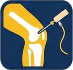 knee arthroscopy