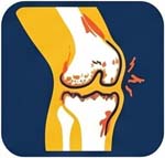 postraumatic knee arthritis